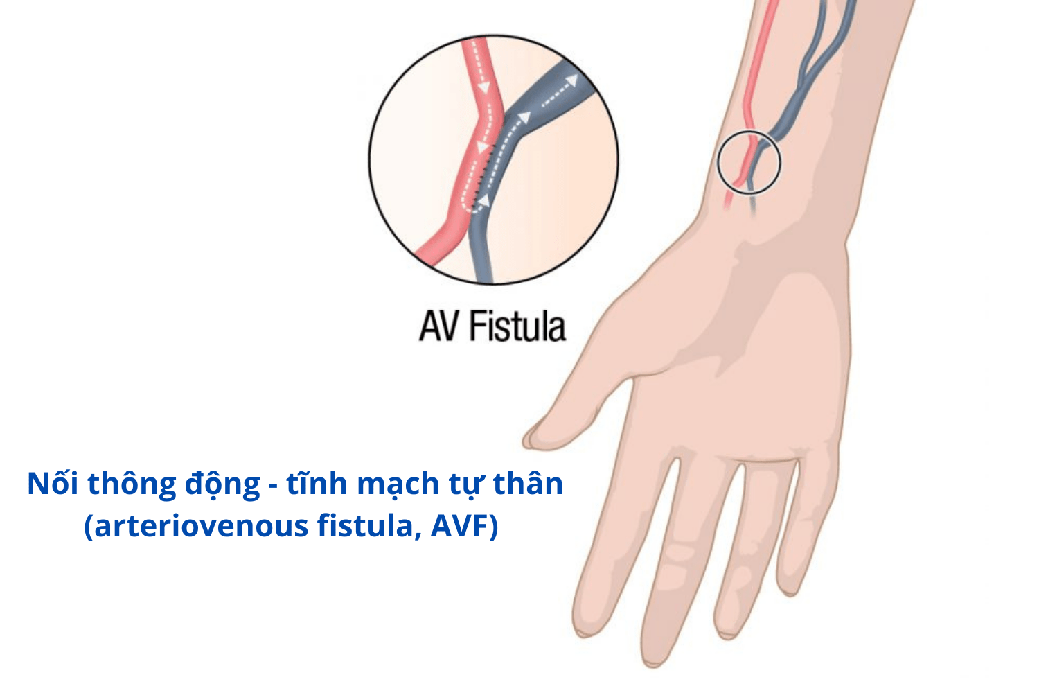 Mổ cầu tay chạy thận – Phẫu thuật AVF