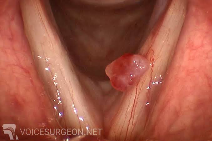 polyp-day-thanh Polyp Dây Thanh