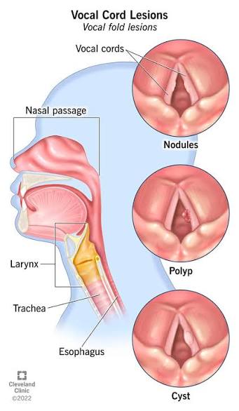 ton-thuong-day-thanh Polyp Dây Thanh